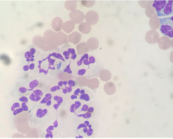 Image of non-degenerate neutrophils in the CSF with single neutrophil containing several long slender bacterial rods. 