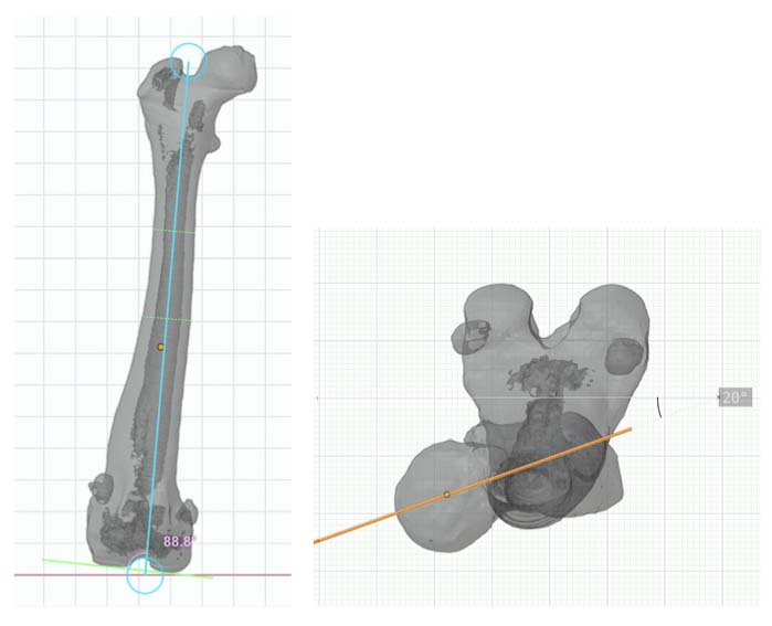 Detailed measurement of the anatomical lateral distal femoral angle (aLDFA) and femoral version in 3D CT planning, illustrating the 88.8-degree angle and 20-degree femoral version.