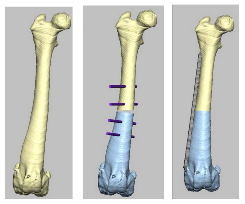 3D surgical planning model of the femur with simulated corrective osteotomy, fixation hardware placement, and color-coded bone segments for visualization.