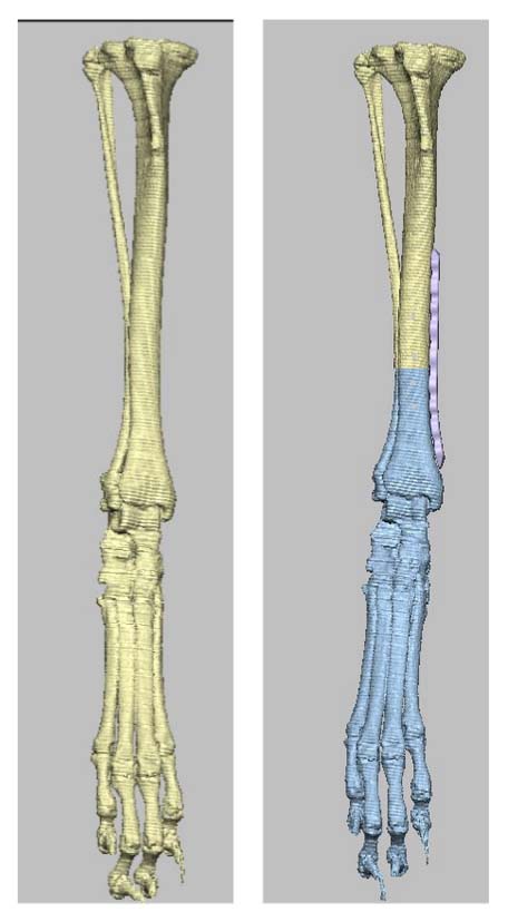 Post-operative 3D visualization of the corrected tibial alignment with hardware fixations in place, demonstrating successful restoration of the limb’s geometry