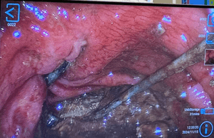 Endoscopic screen image: Close-up view from an endoscope showing the inner lining of a tubular organ, possibly the esophagus or stomach. The mucosa appears reddish and inflamed. A foreign object resembling a wire or stick is lodged in the tissue.