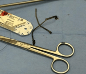 Surgical tray image: A pair of surgical scissors and two dark, possibly corroded or organic-coated wire-like foreign objects lying on a blue surgical drape next to a suture pack. These objects appear to have been surgically removed, possibly matching the items seen in the endoscopic and X-ray images.